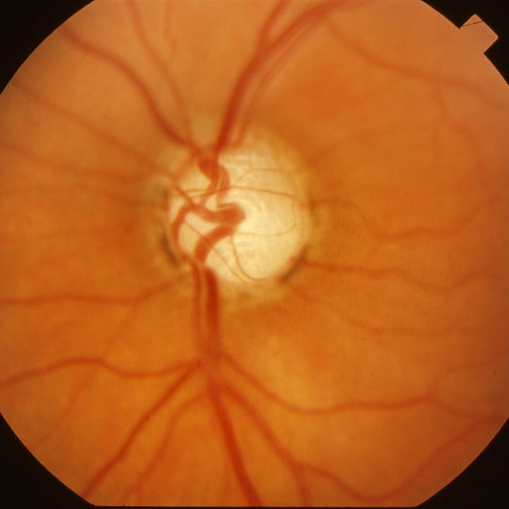Glaucoma Research
