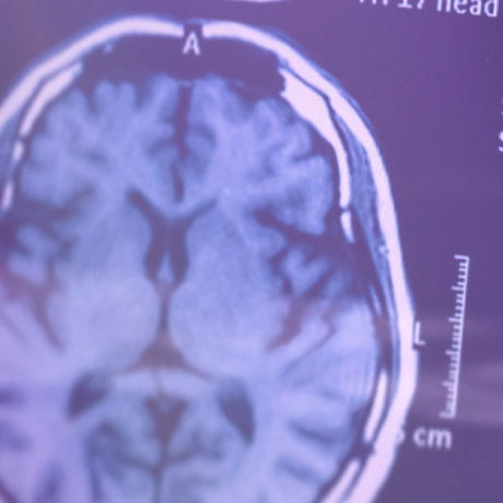 Brain Xray