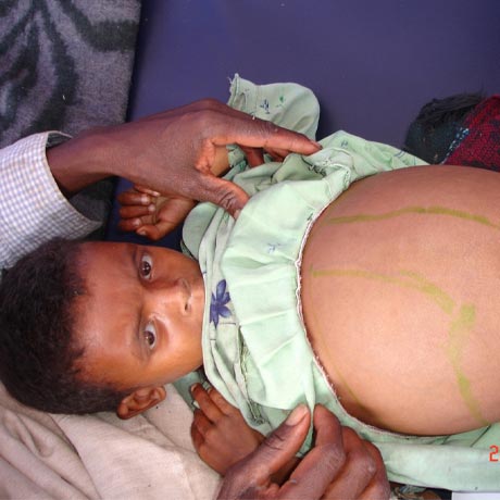 Leishmaniasis