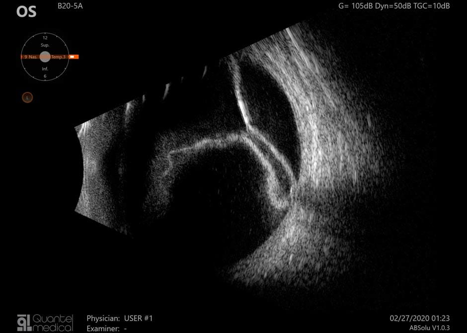 OcularUltrasound