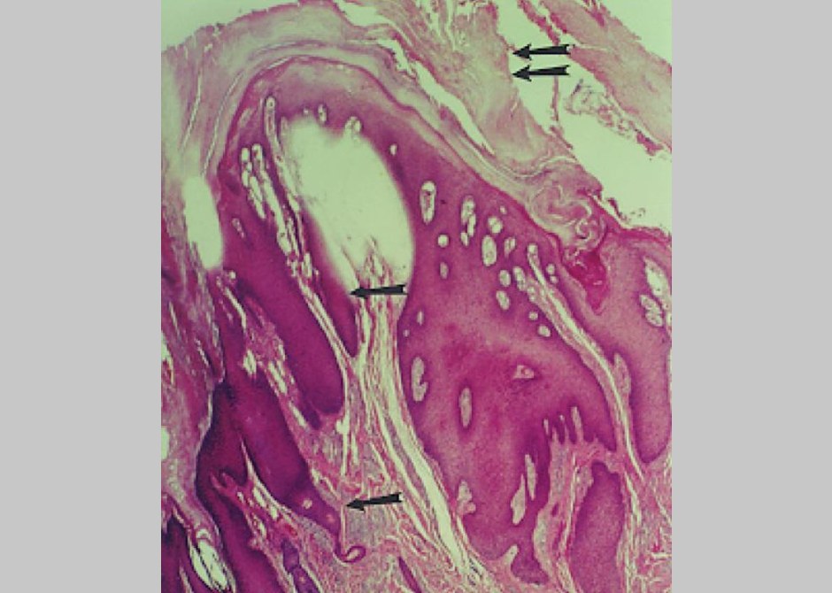 Verrucal keratosis 1