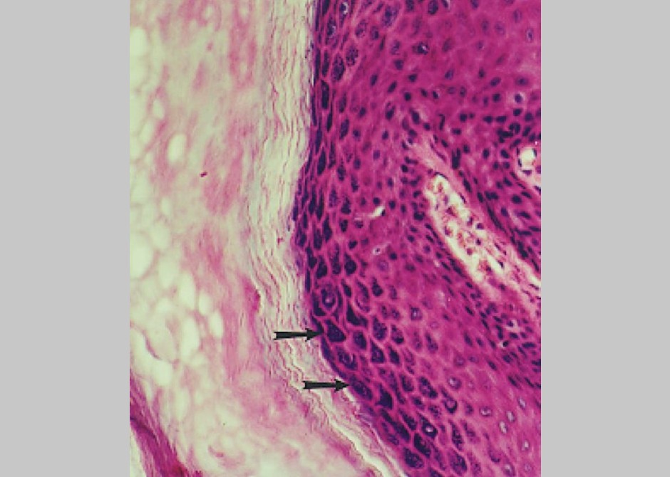 Verrucal keratosis 2