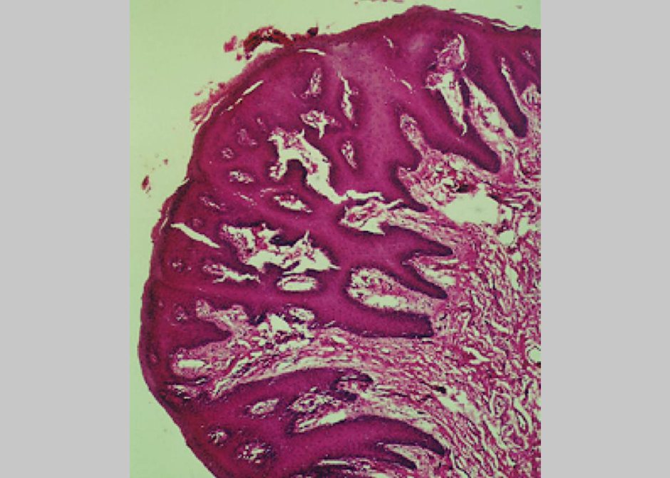 Verrucal keratosis 4