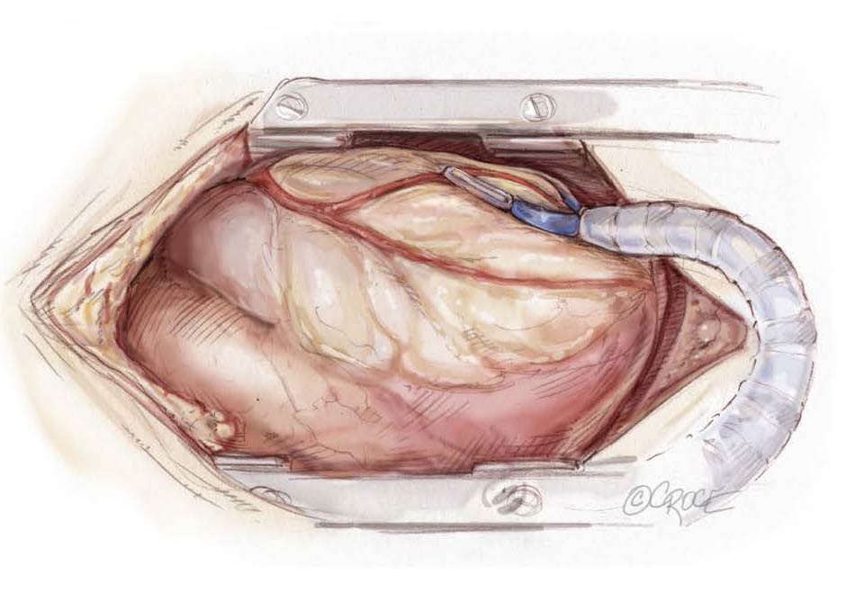 Coronary-Revascularization