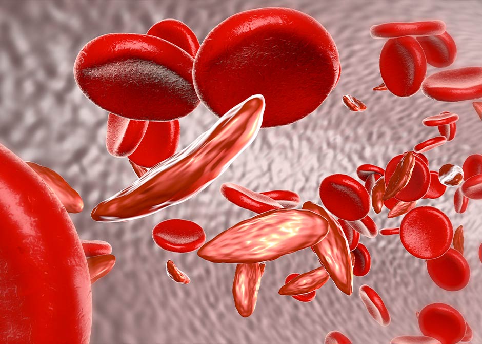 Sickle cell anaemia rendering showing normal red blood cells, and red blood cells affected by sickle cell anaemia.