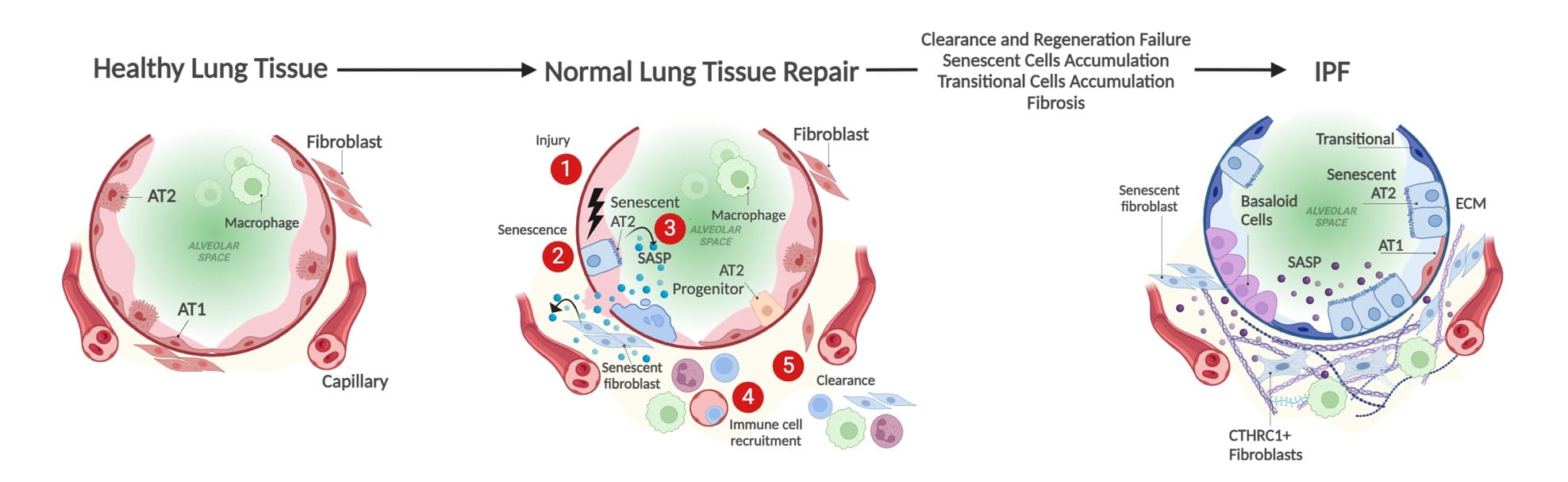 A proposed pathogenic model of Idiopathic Pulmonary Fibrosis in response to persistent injury and altered lung tissue repair.