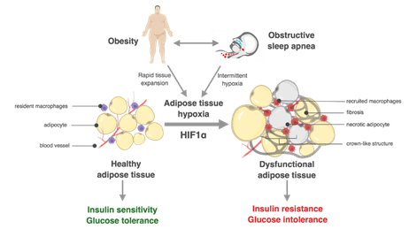 Obstructive sleep apnea is a very common condition that often co-exist with obesity.