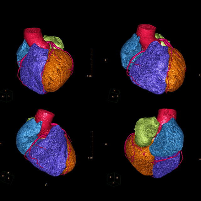 Digital renderings of aorta and its branches