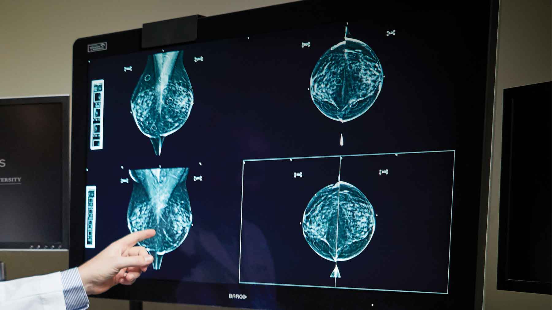 Breast-Cancer-Imaging