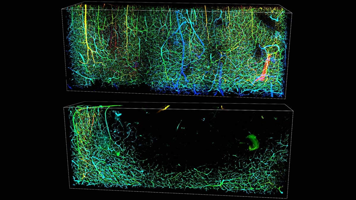 gabapentin in stroke patients
