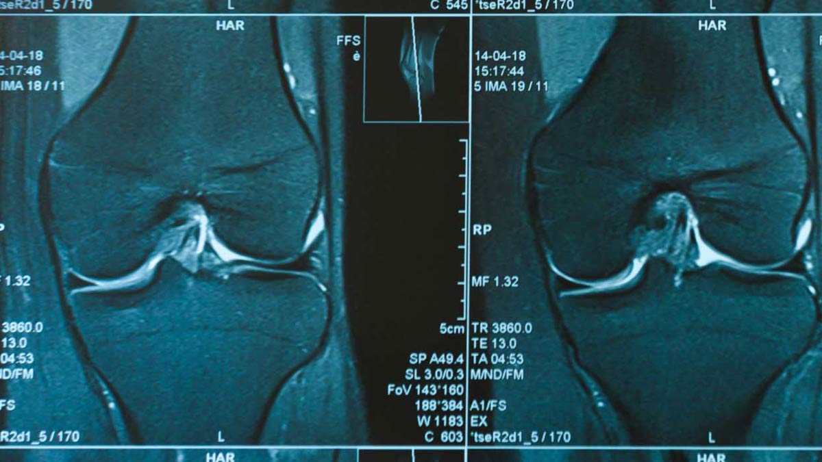 Knee-Scan