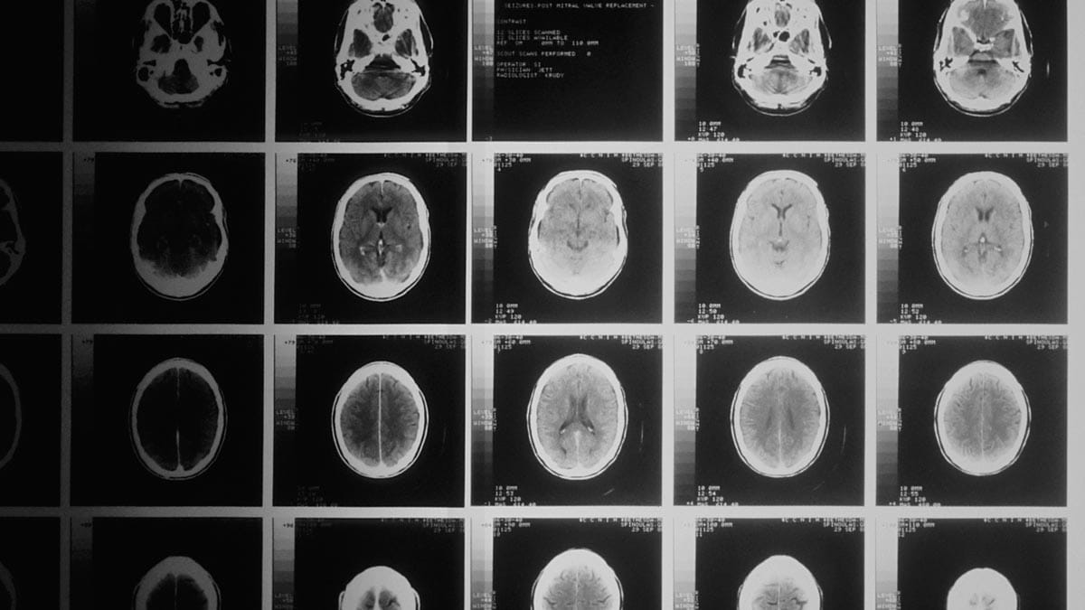 national-cancer-institute-brain-scans