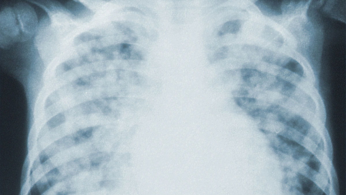 chest xray