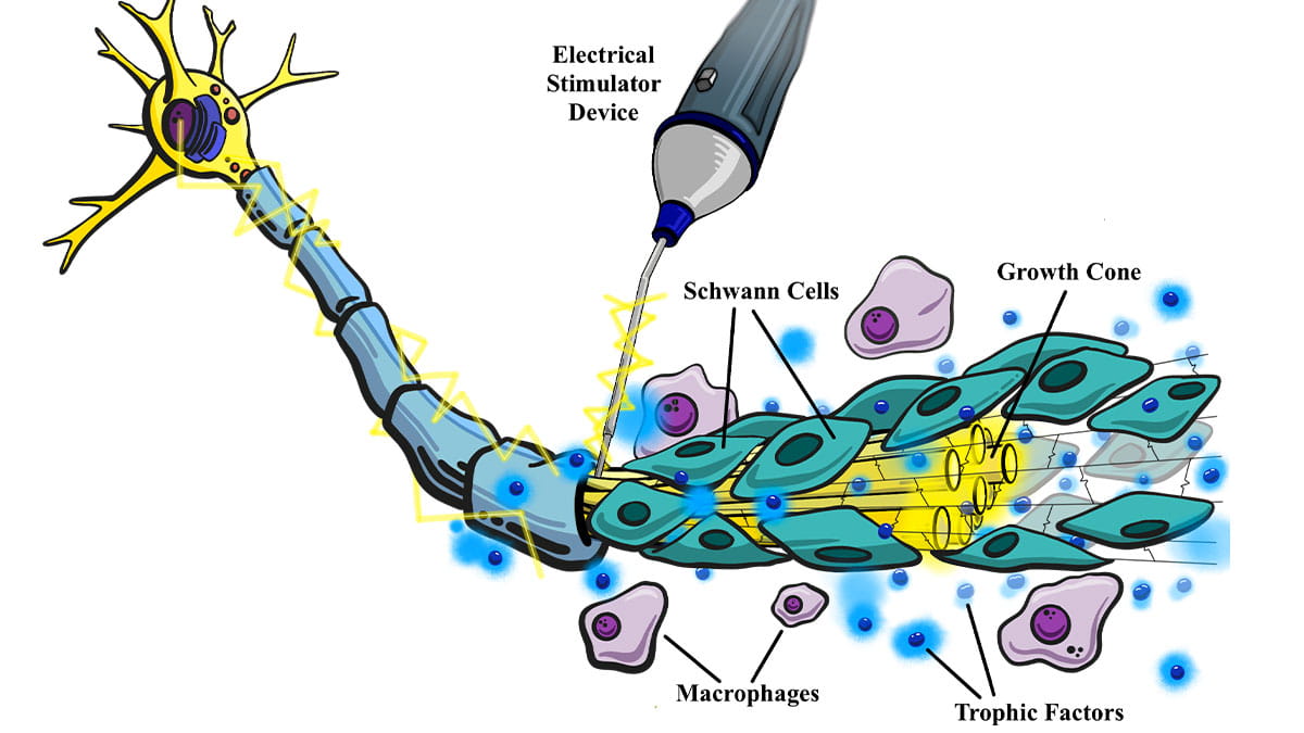 Newly invented electrical stimulation (ES) device improves nerve  regeneration in humans