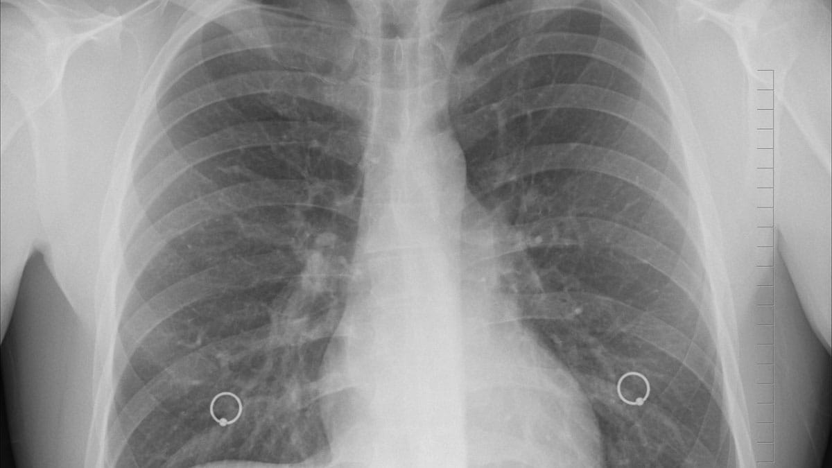 X-ray image of pollution in lungs