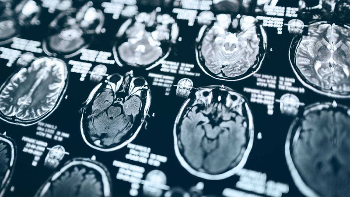 Magnetic Resonance Image (MRI) of a brain