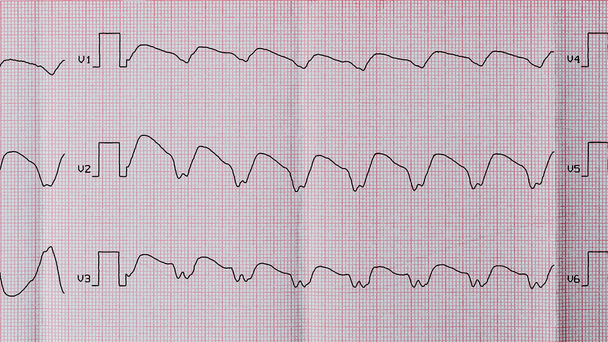 Image of an electrocardiogram