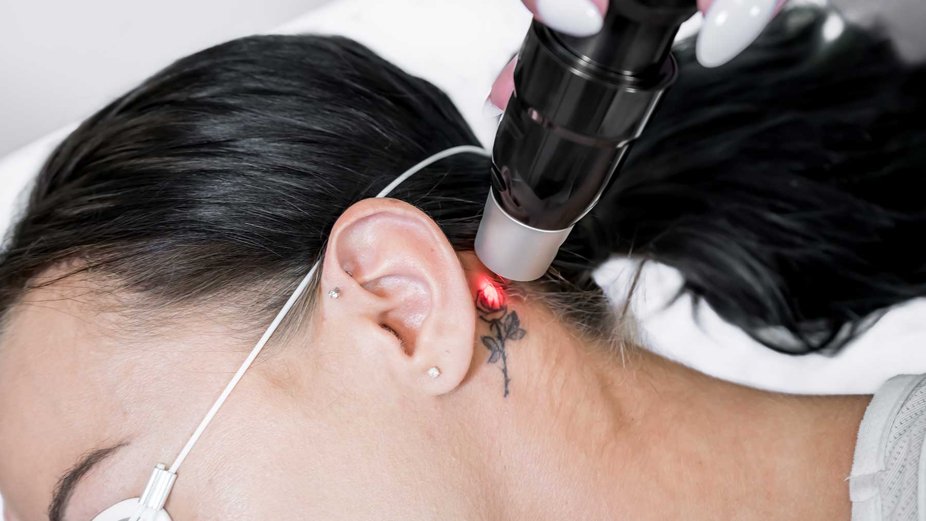 Tattoo-removal_large