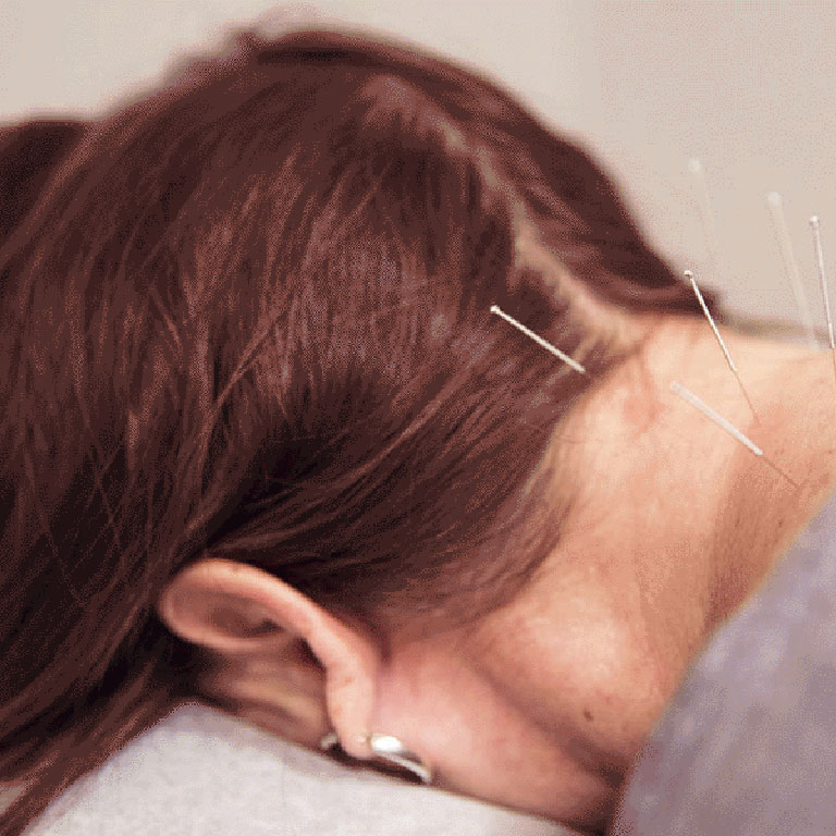 AcupunctureBazzoliFPL