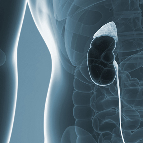 KidneyStones