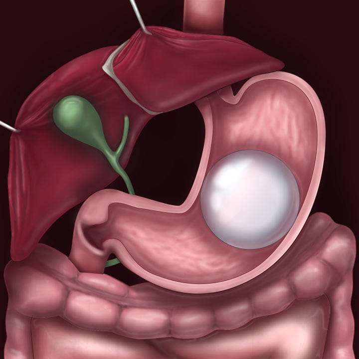 GastricBalloon
