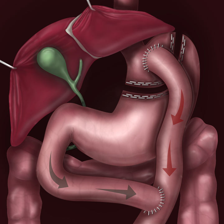GastricBypass