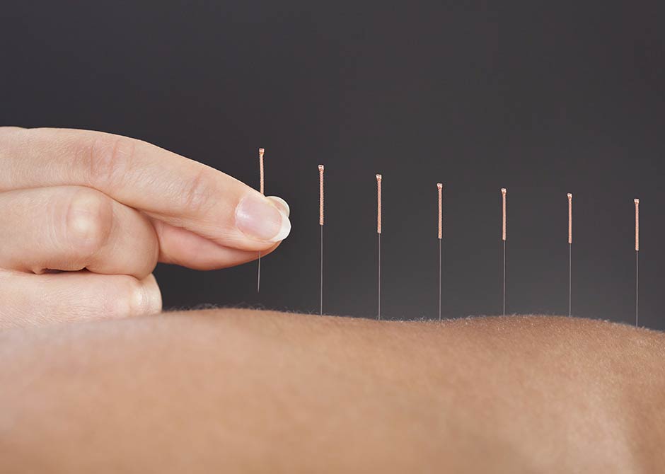 Accupuncture