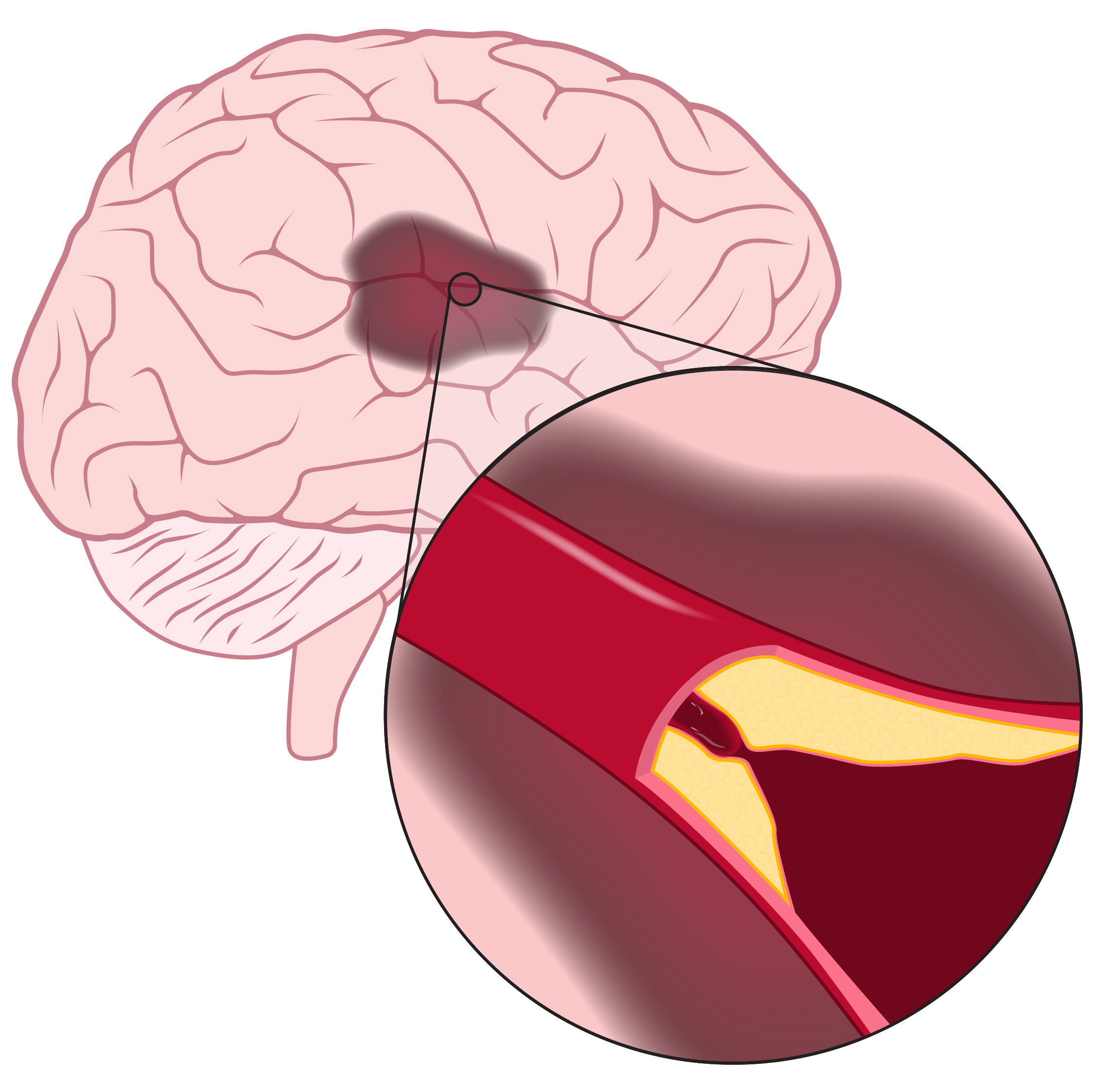 Ischemic stroke illustration