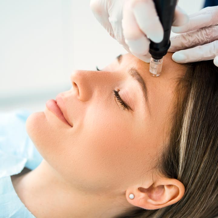 Relaxed woman receiving a microneedling treatment
