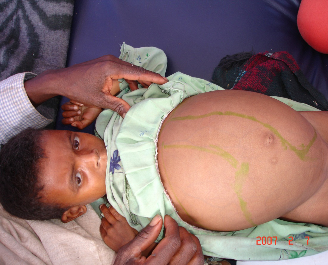 Child with leishmaniasis